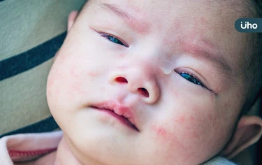 寶寶起紅疹怎麼辦？先別塗藥膏或乳液！醫教寶寶疹子「照護5招」