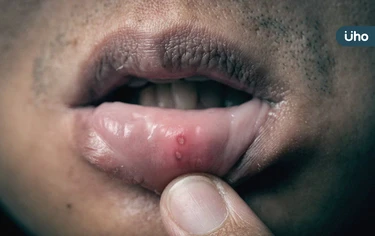 抽菸、飲酒、嚼檳榔是3大危險因子！醫：罹口腔癌「風險高123倍」