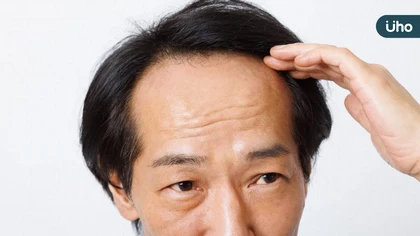 落髮不一定只和荷爾蒙有關 醫：毛囊微環境失衡也可能讓髮量變少