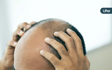 鬼剃頭是什麼？鬼剃頭會自己好嗎？醫揭這些人是好發「圓禿」高風險群