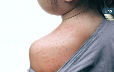 小孩發燒出疹就是玫瑰疹嗎？醫列「幼兒玫瑰疹」典型症狀、併發症