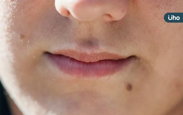 嘴唇黑點竟是癌變警訊？醫揪「黑斑息肉症候群」恐導致腸癌、乳癌