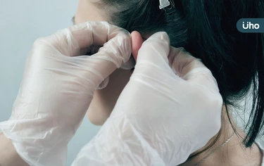 小傷口可能變蟹足腫！女打耳洞「疤痕腫成肉球」醫示警3症狀快就醫