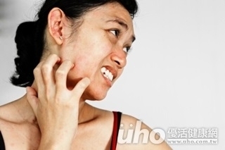 濫用類固醇藥膏 女子痛到睡不著