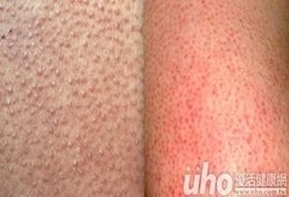 雞皮疙瘩不會消失? 竟是毛囊角化症作怪