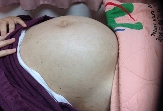 大如「雙胞胎」 她腹藏6公斤子宮肌瘤