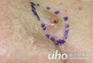 鼻冒「青春痘」 10年沒消竟是皮膚癌