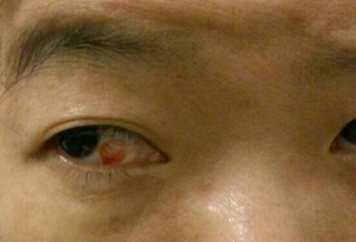 染流感咳到眼睛出血 結膜下微血管破裂所致