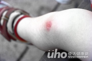 熱敷、滾雞蛋治瘀青?醫:4步驟復原快