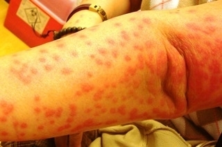 婦手臂出現大片紅點　竟是種花草招來皮膚炎