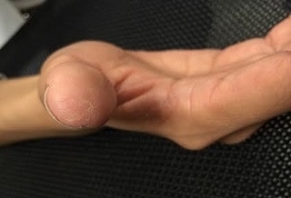 不常洗碗也得富貴手?原來是慢性汗皰疹