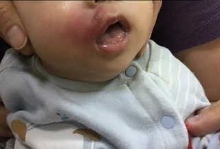 4月嬰遭蚊叮抓破皮　染蜂窩性組織炎