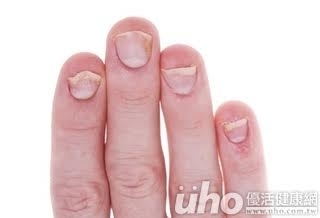 身體微恙嗎?指甲透露警訊