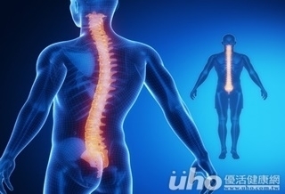長短腳 原是脊椎側彎惹禍