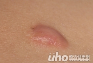 抑制疤痕增生 2招抗留疤!