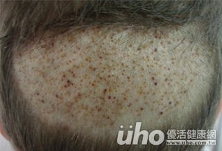 植髮不怕被發現 免剃頭植髮正流行