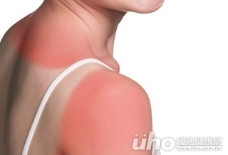 曬傷處理第一步 醫:沖冷水