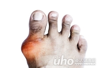 什麼！豆芽是痛風元兇？