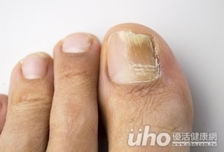 腳癢用手抓 恐感染香港手!