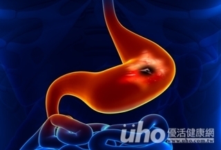 胃癌者有福!8月健保始給付