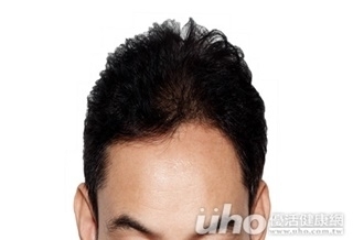 醒來頭髮禿一塊 遭鬼剃頭!?