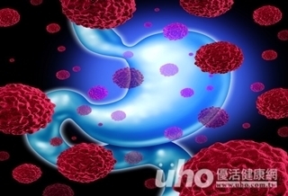 標靶藥物 胃癌可多活5個月
