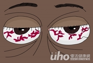 久戴隱眼 紅眼恐致角膜潰瘍
