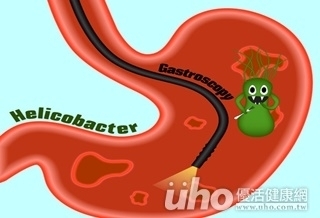 怕照胃鏡 拖延檢查竟致胃癌