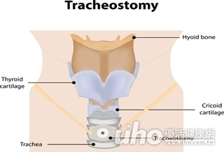 舒適生活 氣切不是終點