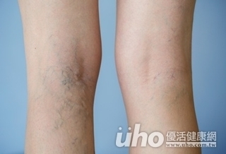 蚯蚓爬上腿 8跡象判別靜脈曲張