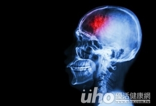 「四高」控制好 遠離年輕型中風