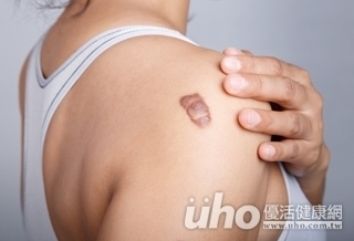 氣滯血瘀 蟹足腫「針」有效