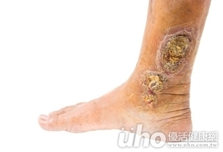 腿腫2倍!竹子釀蜂窩性組織炎