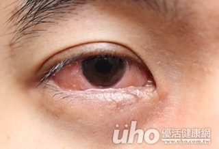 空氣差 眼睛過敏易影響視力