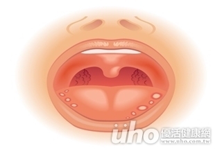 2周還不好?口潰瘍恐癌變