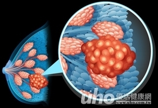 乳房脹痛 良性囊腫竟癌變!