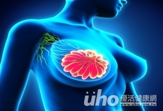無痛腫塊增生 恐為葉狀腫瘤