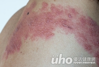 腹部鼓脹長水泡 帶狀皰疹作祟