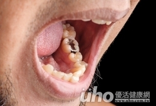 嚇!牙齒填料恐致老年癡呆