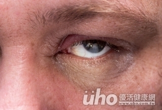 眼皮下垂又複視 恐為肌無力症