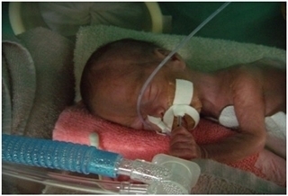 早產兒住院率 高足月兒2倍