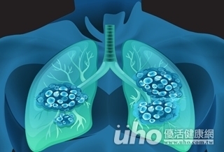 檢查肺癌 半年1次X光最佳