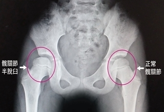 走路像鴨子 竟是髖關節脫臼