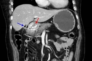 噁心想吐 4公分結石塞住胃