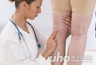 長時間久站　恐致水腫毒！