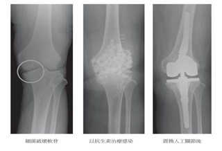 玻尿酸=食鹽水?關節注射效果相同!