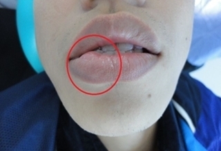 嘴唇水泡是腫瘤?醫師解密