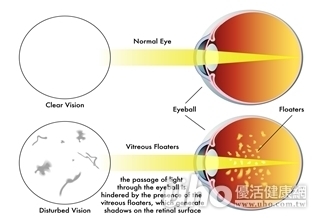 飛蚊變多 小心視網膜剝離!
