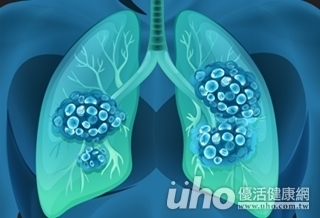 追著腫瘤跑!真光刀治療不傷健康細胞