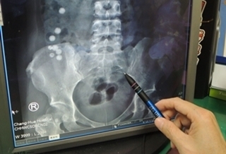 神奇!鐵釘卡腹2年竟沒事